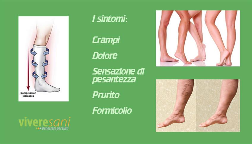 Le varici, solo inestetismo? Le varici, solo inestetismo?